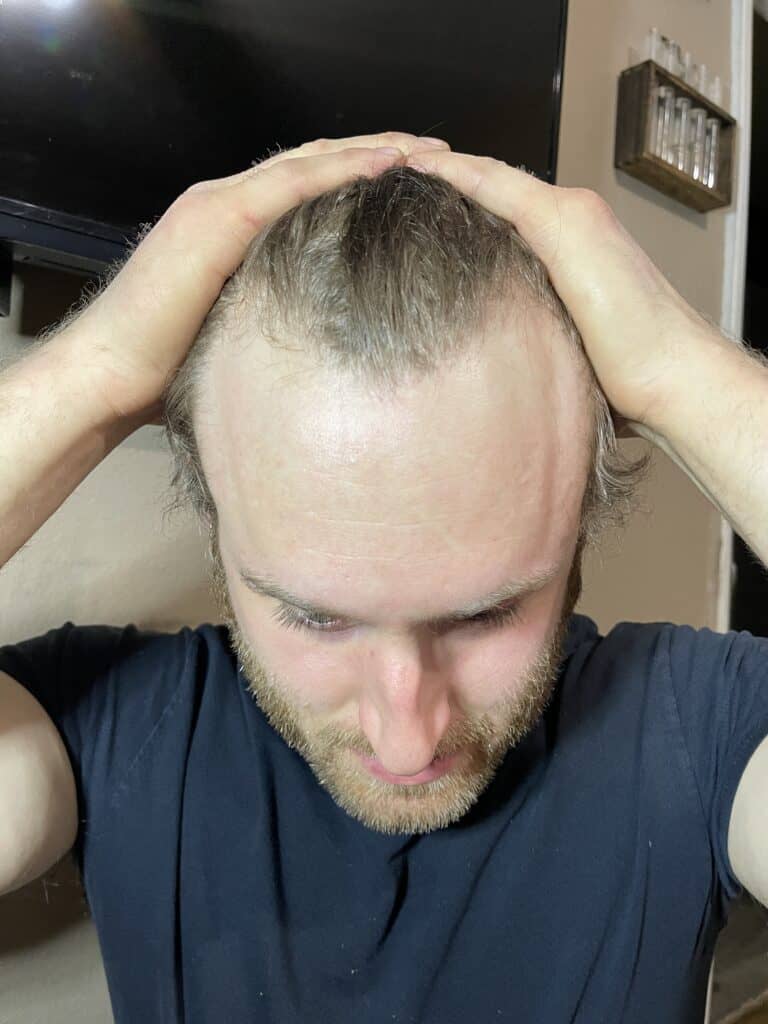 musely review: before and after pics