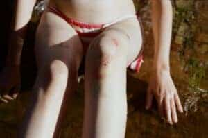 Close-up of a woman's bruised knees and legs sitting outdoors in the sun.